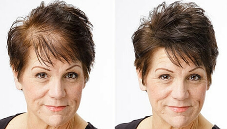 alopeciadepoimento-prc-02.jpg